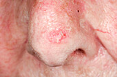 Treatment of actinic keratosis