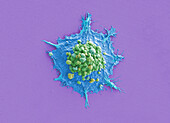 Lung cancer cell, SEM