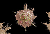 Lung cancer cells, SEM