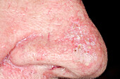 Actinic keratosis