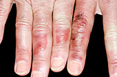 Chilblains on the fingers