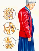 Common osteoporosis fractures, illustration