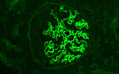 Anti-glomerular basement membrane disease, light micrograph