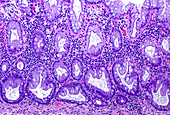Sessile serrated adenoma, light micrograph