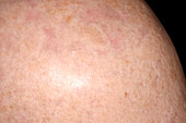 Treatment of actinic keratosis