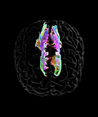 Corpus callosum, DTI MRI scan