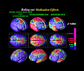 Grey matter loss in very early-onset schizophrenia, brain maps