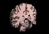 Hippocampi, MRI scan