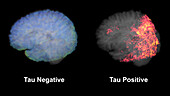 Healthy brain and brain with tau aggregations, MRI scans