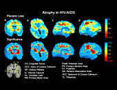 Brain atrophy in HIV/AIDS, MRI scans