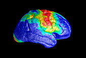 Brain tissue loss in AIDS, MRI scan