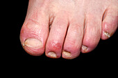 Chilblains on the toes