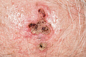 Squamous cell carcinoma