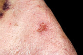 Basal cell carcinoma