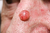 Basal cell carcinoma