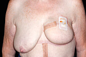 Breast reconstruction after cancer.
