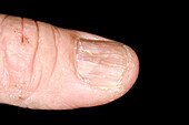 Psoriasis of the fingernail