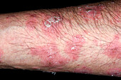 Psoriasis flare-up during treatment