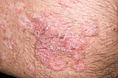 Psoriasis flare-up during treatment