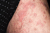 Psoriasis flare-up during treatment