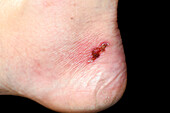 Infected wound on heel