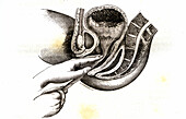 Retained placenta, 19th century illustration