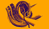 Retained placenta, 19th century illustration