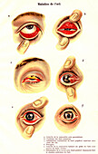 Eye diseases, illustration