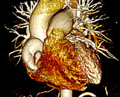 Coronary artery aneurysm, CT scan