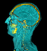 Head and neck blood vessels, CT scan