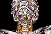 Head and neck blood vessels, CT scan