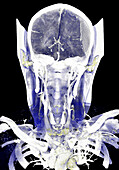 Subdural haematoma, CT scan