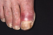 Fungal nail infection on a man's toe