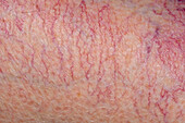 Thread veins on a woman's leg