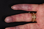 Ischemia on a woman's fingers