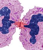 Dividing cancer cell, TEM