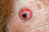 Keratoacanthoma on a woman's scalp