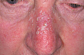 Solar keratosis on a man's nose