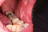 Ulcer in a woman's mouth