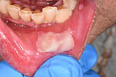 Ulcer in a woman's mouth