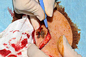 Malignant melanoma excision