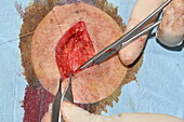 Wound after malignant melanoma excision