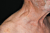 Lump above man's clavicle due to lymphoma