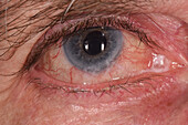 Conjunctival hyperaemia in a woman's eye