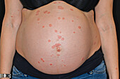 Psoriasis on a pregnant woman's abdomen