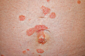Psoriasis on a pregnant woman's abdomen