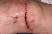 Wound on a woman's knee after fall