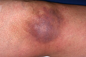 Bruise on a woman's knee after fall