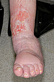 Deformed ankle following fracture