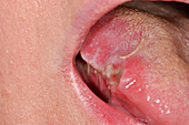 Tongue with dysplasia after biopsy